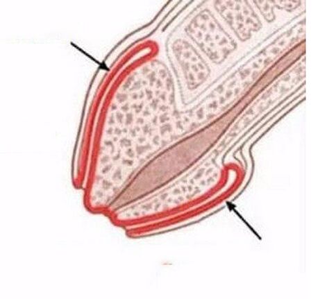 Inflamación del pene