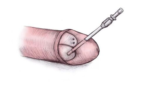 El glande se puede agrandar inyectando gel hialurónico.