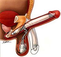 Implantes de alargamiento de pene para hombres